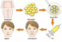 做自体脂肪面部填充的注意事项