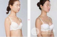 自体脂肪隆胸的缺点