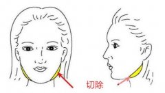 咬肌大怎么办 咬肌切除术