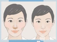 哪些人不能做颧骨整形？