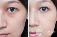 泪沟泪袋怎样去除?去除泪沟Z快速有的办法是什么? 泪沟泪袋怎样去除?去除泪沟Z快速有的办法是什么?