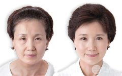 激光除皱的果怎么样？有没有什么风险和危害？