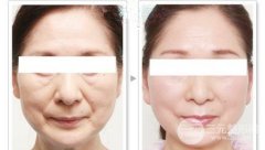 激光去除皱纹有哪些优势及特点？