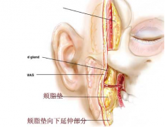 做脸部颊脂去除手术后脸会松弛吗？