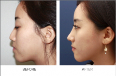 假体隆鼻取出假体后鼻子会变形吗？