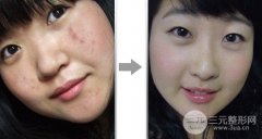 彩光可以去痘印吗？彩光祛痘真的有果吗？