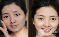 彩光嫩肤有副作用吗？可以缓解红血丝吗？