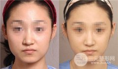 面部抽脂吸脂减肥手术具体步骤详解