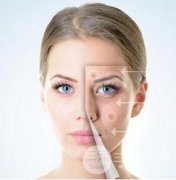 激光嫩肤原理是什么？哪些人适合做？