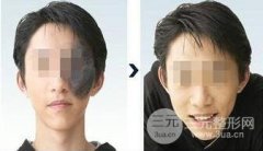 冷冻法去太田痣术后怎么保养？