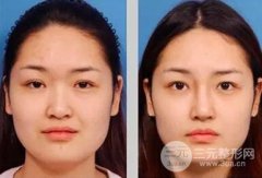 玻尿酸隆鼻的六大优势你都知道吗？