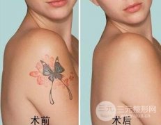 激光洗纹身好吗?优点有哪些? 激光洗纹身好吗?优点有哪些?