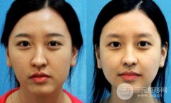 哪些人不适合做歪鼻矫正? 哪些人不适合做歪鼻矫正?