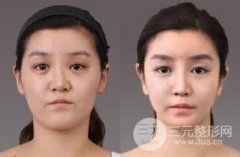 隆鼻假体取出术前和术后注意事项有哪些?