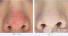 彩光缓解酒渣鼻果好不好?