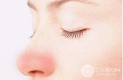 激光缓解酒糟鼻会有副作用吗?
