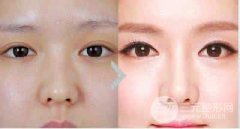 面部美容激光缓解酒渣鼻的有哪些优势？