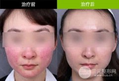 缓解酒渣鼻前后的准备和护理事项有哪些?