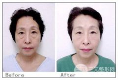 复合彩光嫩肤是什么，有什么特点？