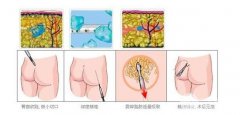 臀部吸脂缩臀果怎么样,价格贵不贵 臀部吸脂缩臀果怎么样,价格贵不贵