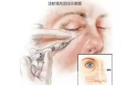 玻尿酸填充全脸价格,果好不好 玻尿酸填充全脸价格,果好不好