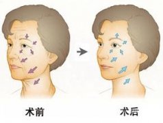 电波l皮果好不好,会反弹吗 电波l皮果好不好,会反弹吗