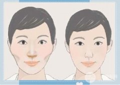 韩式颧骨整形手术的方法