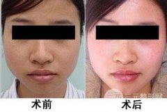 复合彩光有美白嫩肤的果吗？