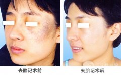 胎记怎样去除？激光去除胎记可行吗？
