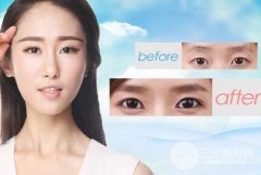 做了埋线双眼皮多久才能化妆？