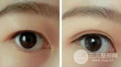 埋线双眼皮能永.久保持吗？