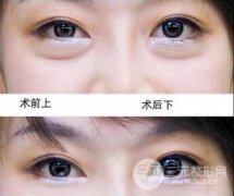 眼袋吸脂有后遗症较轻(不代表不会出现后遗症)? 眼袋吸脂有后遗症较轻(不代表不会出现后遗症)?