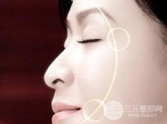 电波l皮的优点和缺点分别是什么？