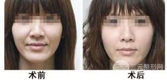 面部美容激光去除法令纹有哪些优点?