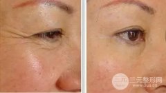 上海眼部电波l皮，真人果分享。