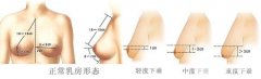 乳房下垂矫正果好不好,多少钱 乳房下垂矫正果好不好,多少钱