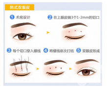 双眼皮的优点,能维持多长时间 双眼皮的优点,能维持多长时间