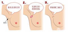 有副乳怎么样,可以切除吗,果好不好 有副乳怎么样,可以切除吗,果好不好