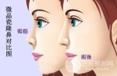 微晶磨削祛斑果好不好,做多少次才有果 微晶磨削祛斑果好不好,做多少次才有果