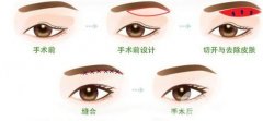 三角眼怎么样矫正,果好不好 三角眼怎么样矫正,果好不好