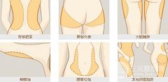 激光溶脂有什么副作用,果怎么样 激光溶脂有什么副作用,果怎么样
