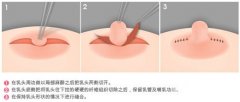 乳晕缩小的方法 乳晕缩小的方法