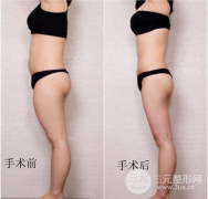 超声吸脂降低风险吗？减肥果怎么样？