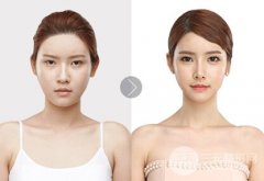 玻尿酸隆鼻后鼻子的触感会很奇怪吗？