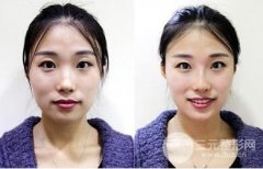 玻尿酸隆鼻有风险较低（不代表没有风险）？注意事项有哪些？