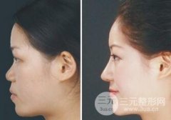 注射隆鼻失败了怎么办？专家这样说