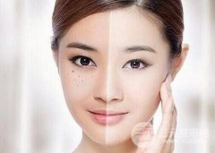 光子嫩肤可以缓解雀斑吗？