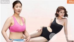 做个全身水动力抽脂减肥需要多少钱？