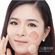 微晶磨皮祛疤痕术后怎么护理？