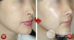 口唇整形美容厚唇修薄术术后注意事项有哪些?